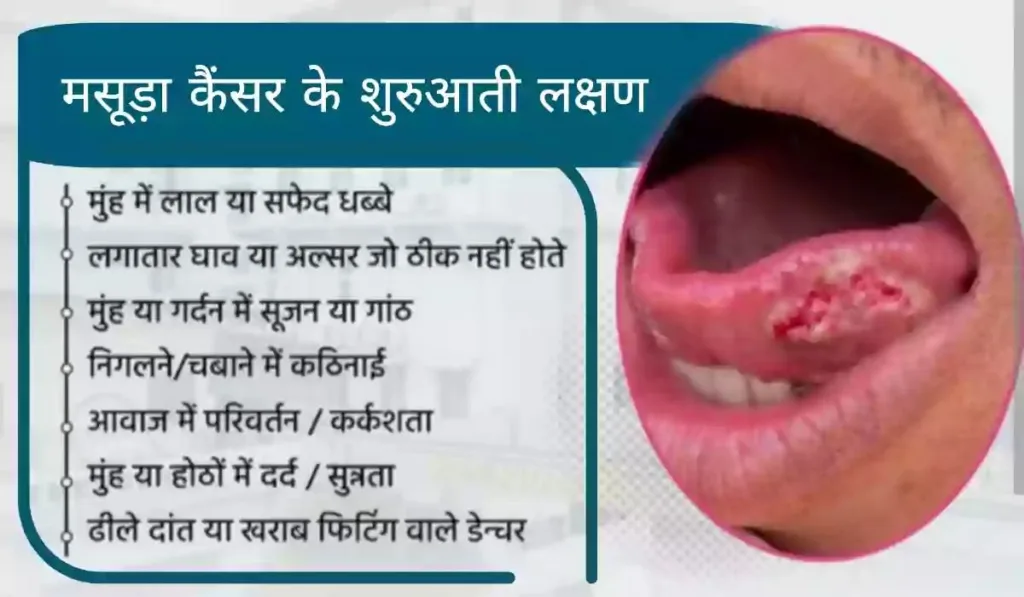 इस फोटो में मसूड़ा कैंसर की शुरुआती लक्षणों के बारे में दिखाया गया है।